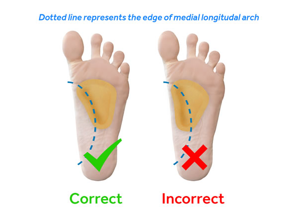 Metatarsal Pads Positioned with Longitudal Arch metatarsal-pad-longitudal-arch